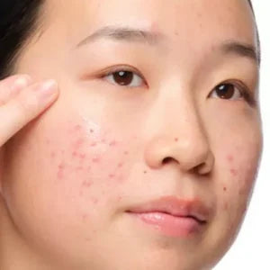 Acne →
